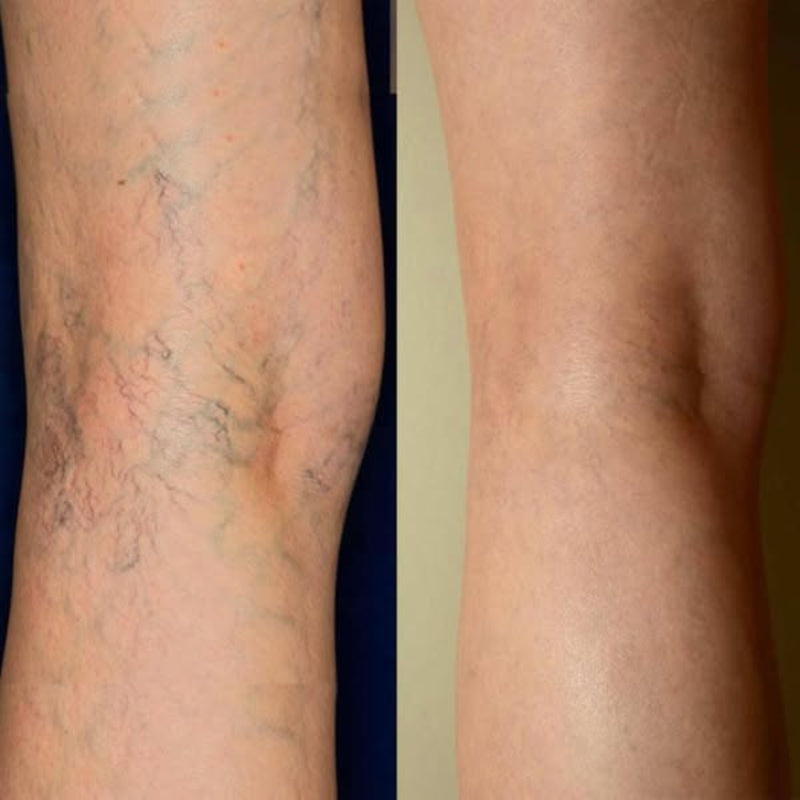 Vein Restore™ | Triple-Enzyme Circulation Support